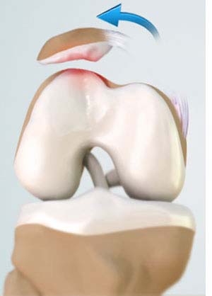 Patella Fracture